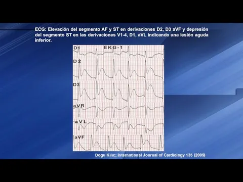 ECG: Elevación del segmento AF y ST en derivaciones D2, D3 aVF