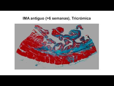 Dr. Juan Rodriguez-T IMA antiguo (>6 semanas), Tricrómica