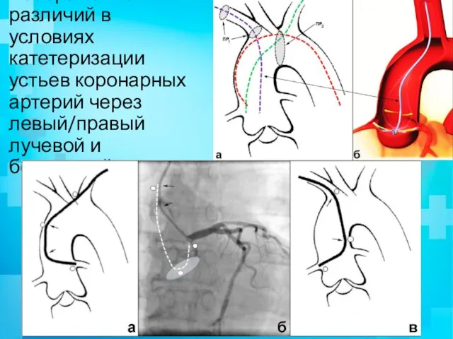 Изображение различий в условиях катетеризации устьев коронарных артерий через левый/правый лучевой и бедренный доступы:
