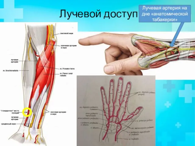 Лучевой доступ Лучевая артерия на дне «анатомической табакерки»