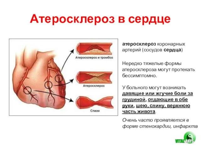Атеросклероз в сердце атеросклероз коронарных артерий (сосудов сердца) Очень часто проявляется в