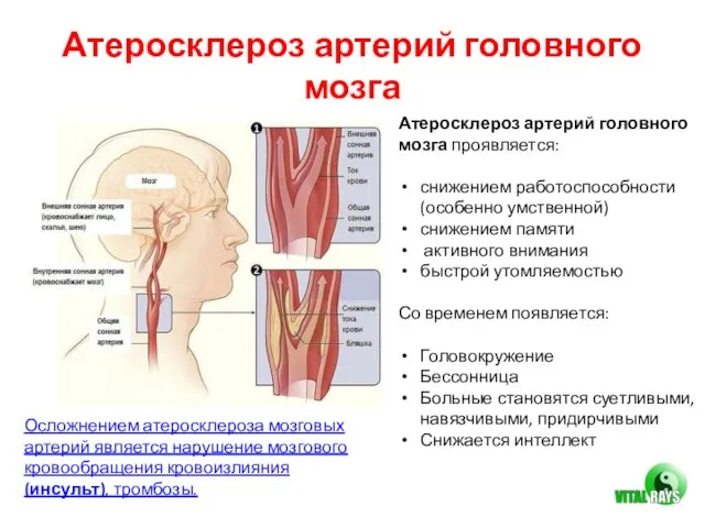 Атеросклероз артерий головного мозга Атеросклероз артерий головного мозга проявляется: снижением работоспособности (особенно
