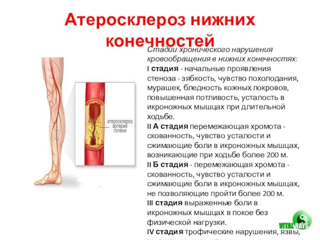 Атеросклероз нижних конечностей Стадии хронического нарушения кровообращения в нижних конечностях: I стадия