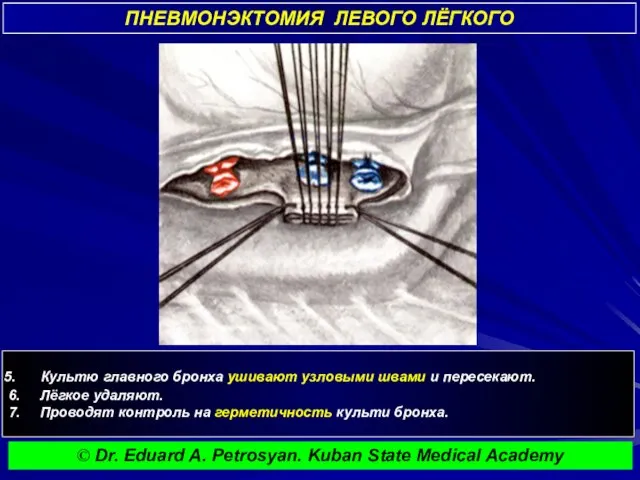 ПНЕВМОНЭКТОМИЯ ЛЕВОГО ЛЁГКОГО © Dr. Eduard A. Petrosyan. Kuban State Medical Academy