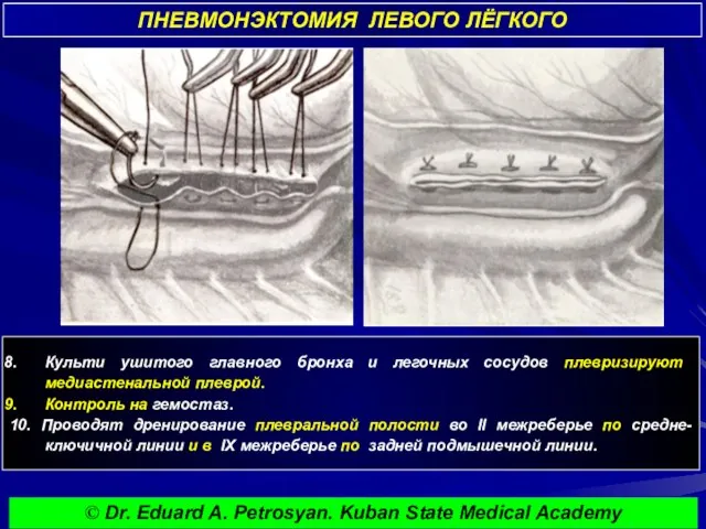 ПНЕВМОНЭКТОМИЯ ЛЕВОГО ЛЁГКОГО © Dr. Eduard A. Petrosyan. Kuban State Medical Academy