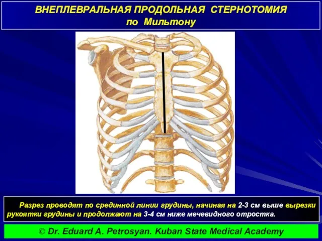 ВНЕПЛЕВРАЛЬНАЯ ПРОДОЛЬНАЯ СТЕРНОТОМИЯ по Мильтону Разрез проводят по срединной линии грудины, начиная