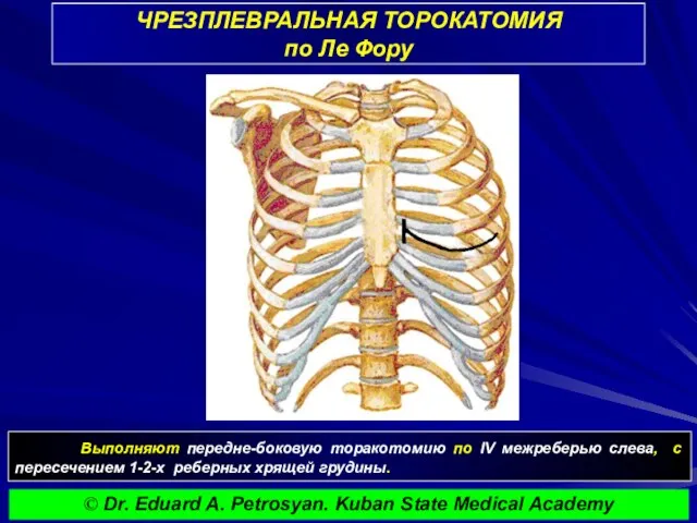 ЧРЕЗПЛЕВРАЛЬНАЯ ТОРОКАТОМИЯ по Ле Фору Выполняют передне-боковую торакотомию по IV межреберью слева,