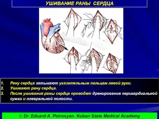 УШИВАНИЕ РАНЫ СЕРДЦА Рану сердца затыкают указательным пальцем левой руки. Ушивают рану