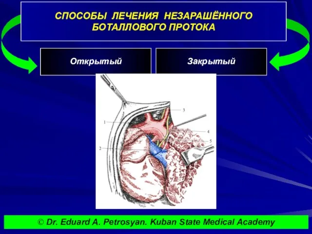 СПОСОБЫ ЛЕЧЕНИЯ НЕЗАРАШЁННОГО БОТАЛЛОВОГО ПРОТОКА © Dr. Eduard A. Petrosyan. Kuban State Medical Academy Открытый Закрытый