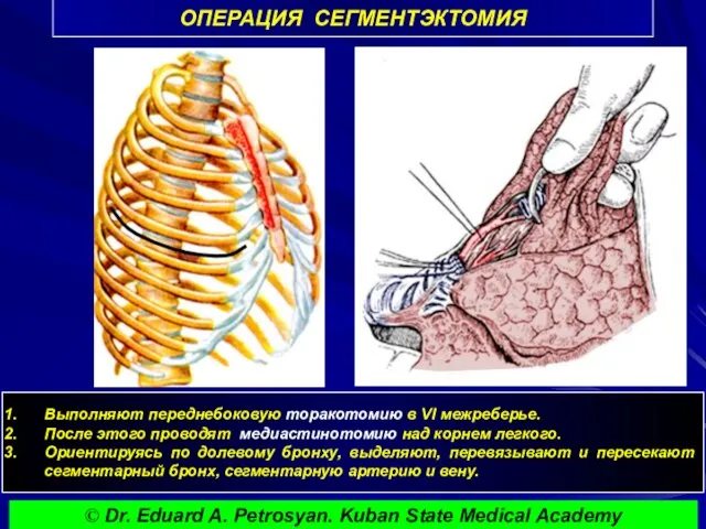 ОПЕРАЦИЯ СЕГМЕНТЭКТОМИЯ Выполняют переднебоковую торакотомию в VI межреберье. После этого проводят медиастинотомию