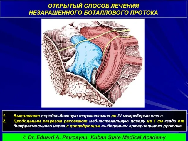 ОТКРЫТЫЙ СПОСОБ ЛЕЧЕНИЯ НЕЗАРАШЕННОГО БОТАЛЛОВОГО ПРОТОКА Выполняют передне-боковую торакотомию по IV межреберью