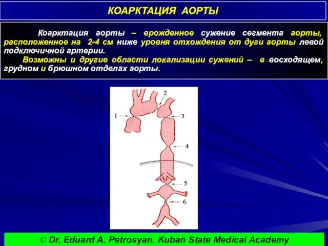 КОАРКТАЦИЯ АОРТЫ Коарктация аорты – врожденное сужение сегмента аорты, расположенное на 2-4