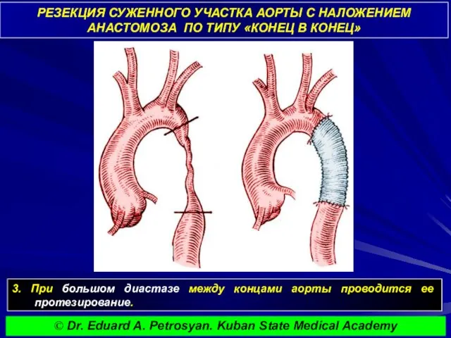 РЕЗЕКЦИЯ СУЖЕННОГО УЧАСТКА АОРТЫ С НАЛОЖЕНИЕМ АНАСТОМОЗА ПО ТИПУ «КОНЕЦ В КОНЕЦ»