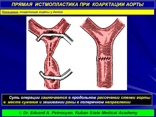 ПРЯМАЯ ИСТМОПЛАСТИКА ПРИ КОАРКТАЦИИ АОРТЫ Суть операции заключается в продольном рассечении стенки