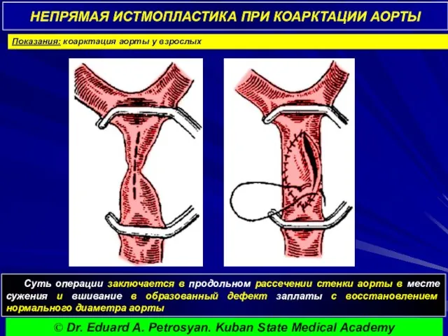 НЕПРЯМАЯ ИСТМОПЛАСТИКА ПРИ КОАРКТАЦИИ АОРТЫ Суть операции заключается в продольном рассечении стенки