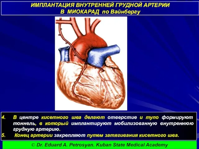 ИМПЛАНТАЦИЯ ВНУТРЕННЕЙ ГРУДНОЙ АРТЕРИИ В МИОКАРАД по Вайнбергу В центре кисетного шва