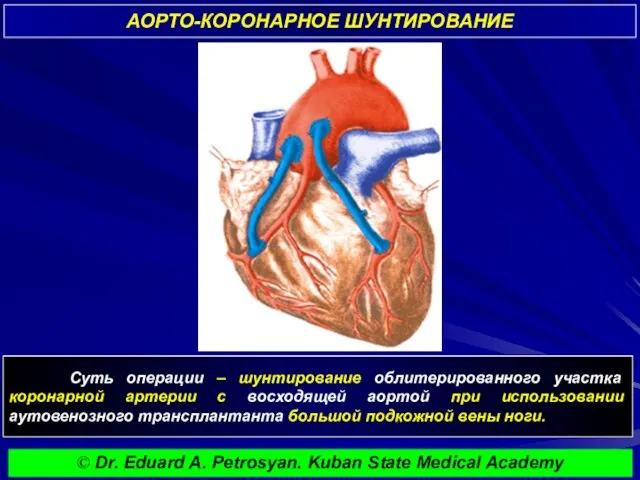 АОРТО-КОРОНАРНОЕ ШУНТИРОВАНИЕ Суть операции – шунтирование облитерированного участка коронарной артерии с восходящей