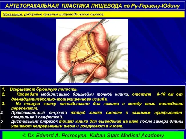 АНТЕТОРАКАЛЬНАЯ ПЛАСТИКА ПИЩЕВОДА по Ру-Герцену-Юдину 1. Вскрывают брюшную полость. 2. Проводят мобилизацию