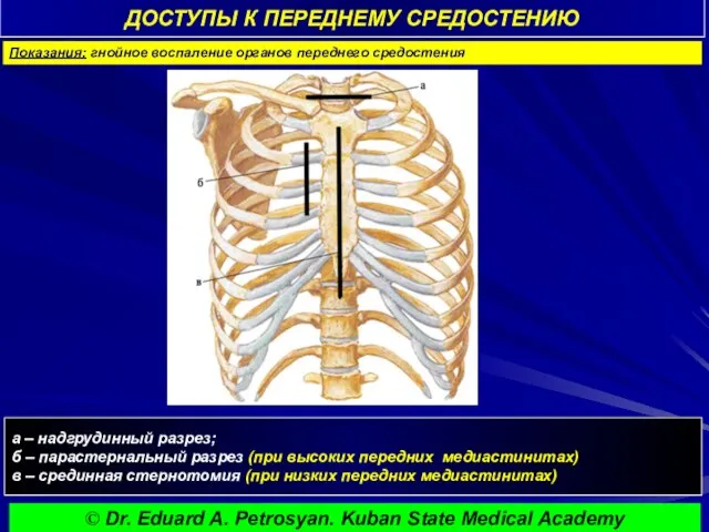 ДОСТУПЫ К ПЕРЕДНЕМУ СРЕДОСТЕНИЮ а – надгрудинный разрез; б – парастернальный разрез