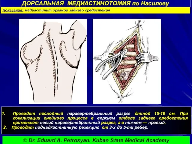 ДОРСАЛЬНАЯ МЕДИАСТИНОТОМИЯ по Насилову Проводят послойный паравертебральный разрез длиной 15-18 см. При