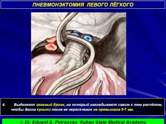 ПНЕВМОНЭКТОМИЯ ЛЕВОГО ЛЁГКОГО © Dr. Eduard A. Petrosyan. Kuban State Medical Academy