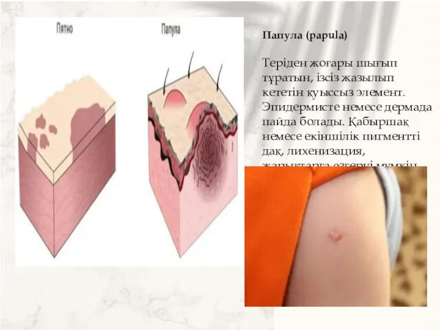 Папула (papula) Теріден жоғары шығып тұратын, ізсіз жазылып кететін қуыссыз элемент. Эпидермисте