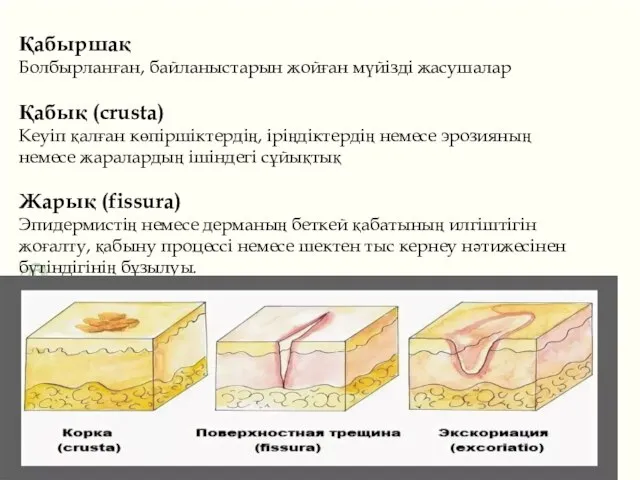 Қабыршақ Болбырланған, байланыстарын жойған мүйізді жасушалар Қабық (crusta) Кеуіп қалған көпіршіктердің, іріңдіктердің