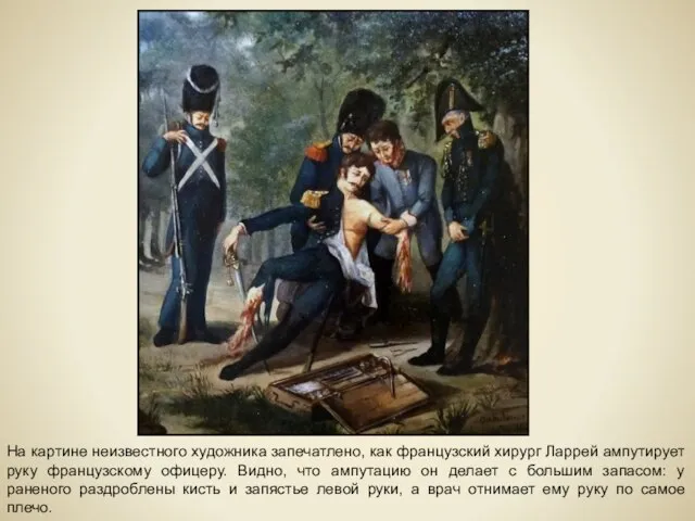 На картине неизвестного художника запечатлено, как французский хирург Ларрей ампутирует руку французскому