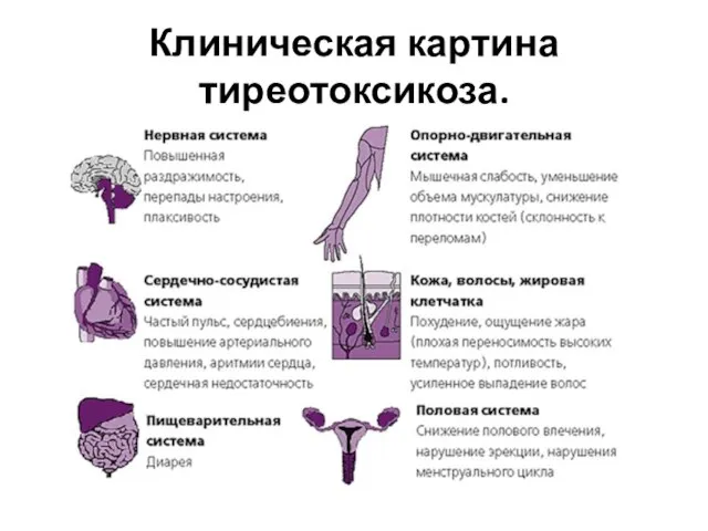 Клиническая картина тиреотоксикоза.