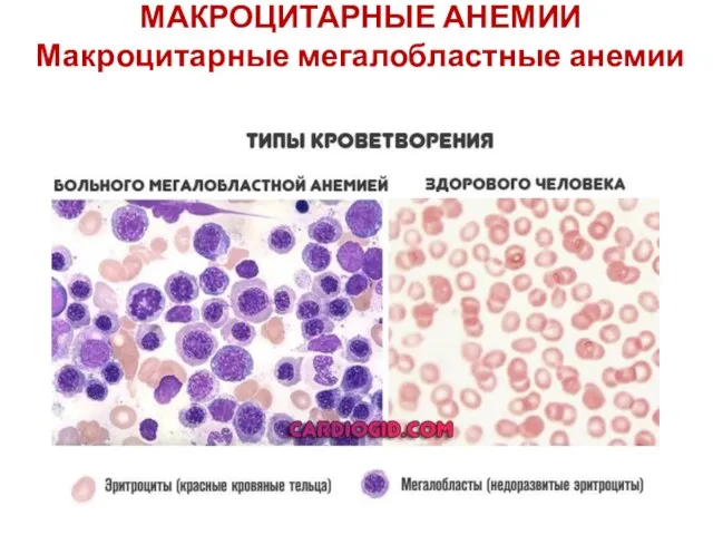 МАКРОЦИТАРНЫЕ АНЕМИИ Макроцитарные мегалобластные анемии