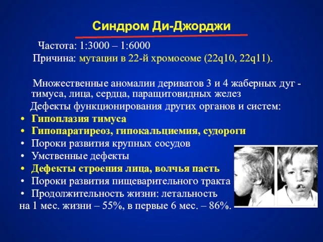 Синдром Ди-Джорджи Частота: 1:3000 – 1:6000 Причина: мутации в 22-й хромосоме (22q10,