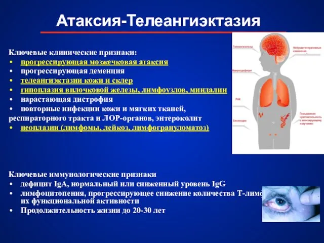 Атаксия-Телеангиэктазия Ключевые клинические признаки: прогрессирующая мозжечковая атаксия прогрессирующая деменция телеангиэктазии кожи и