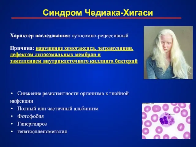 Синдром Чедиака-Хигаси Характер наследования: аутосомно-рецессивный Причина: нарушение хемотаксиса, дегрануляции, дефектом лизосомальных мембран