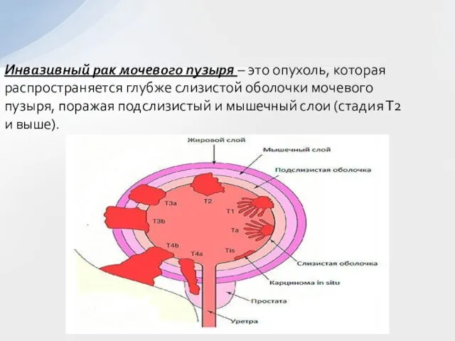 Инвазивный рак мочевого пузыря – это опухоль, которая распространяется глубже слизистой оболочки