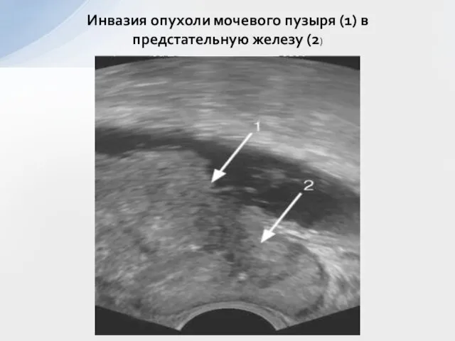 Инвазия опухоли мочевого пузыря (1) в предстательную железу (2)