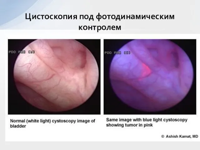 Цистоскопия под фотодинамическим контролем