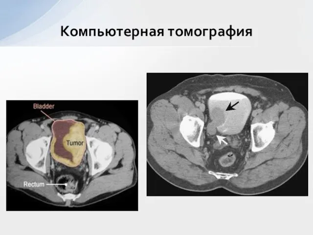 Компьютерная томография