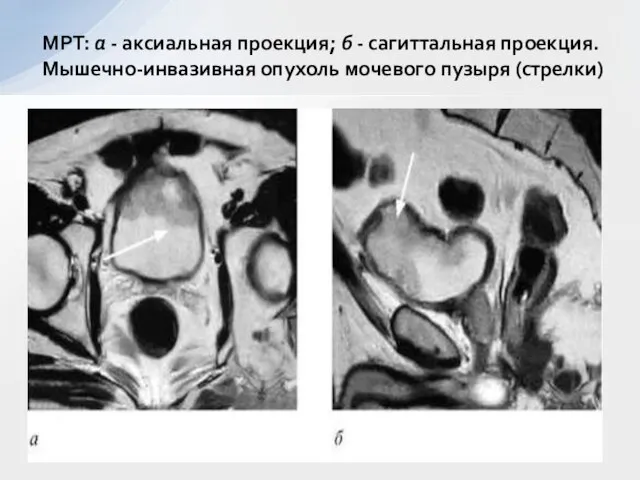 МРТ: а - аксиальная проекция; б - сагиттальная проекция. Мышечно-инвазивная опухоль мочевого пузыря (стрелки)