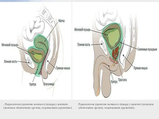 . Радикальное удаление мочевого пузыря у женщин (зеленым обозначены органы, подлежащие удалению).