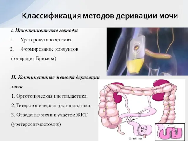 I. Инконтинентные методы Уретерокутанеостомия Формирование кондуитов ( операция Брикера) II. Континентные методы