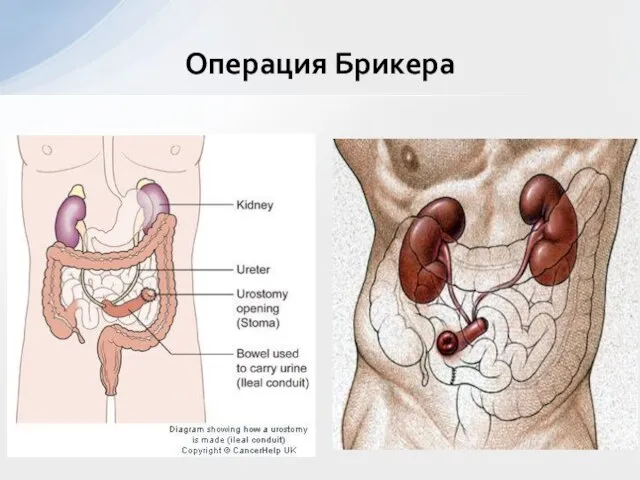 Операция Брикера