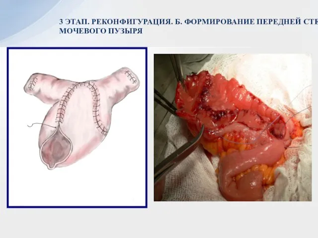 3 ЭТАП. РЕКОНФИГУРАЦИЯ. Б. ФОРМИРОВАНИЕ ПЕРЕДНЕЙ СТЕНКИ МОЧЕВОГО ПУЗЫРЯ