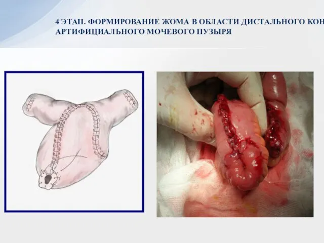 4 ЭТАП. ФОРМИРОВАНИЕ ЖОМА В ОБЛАСТИ ДИСТАЛЬНОГО КОНЦА АРТИФИЦИАЛЬНОГО МОЧЕВОГО ПУЗЫРЯ