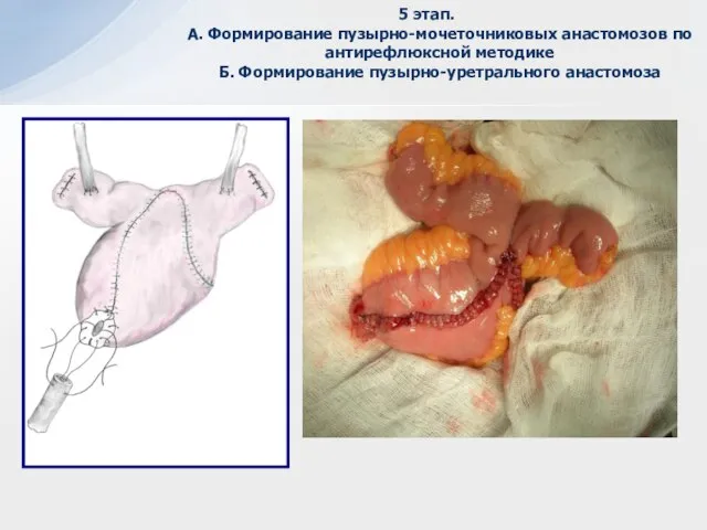 5 этап. А. Формирование пузырно-мочеточниковых анастомозов по антирефлюксной методике Б. Формирование пузырно-уретрального анастомоза