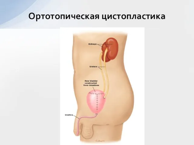 Ортотопическая цистопластика