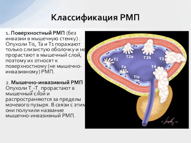 1. Поверхностный РМП (без инвазии в мышечную стенку) . Опухоли Тis, Та