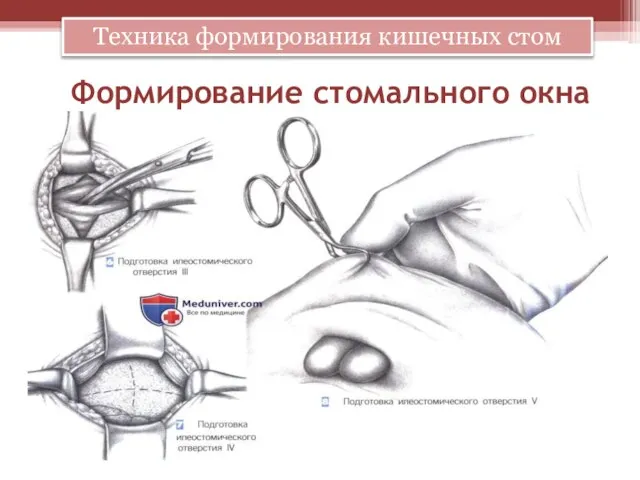 Формирование стомального окна Техника формирования кишечных стом