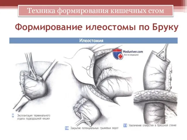 Формирование илеостомы по Бруку Техника формирования кишечных стом