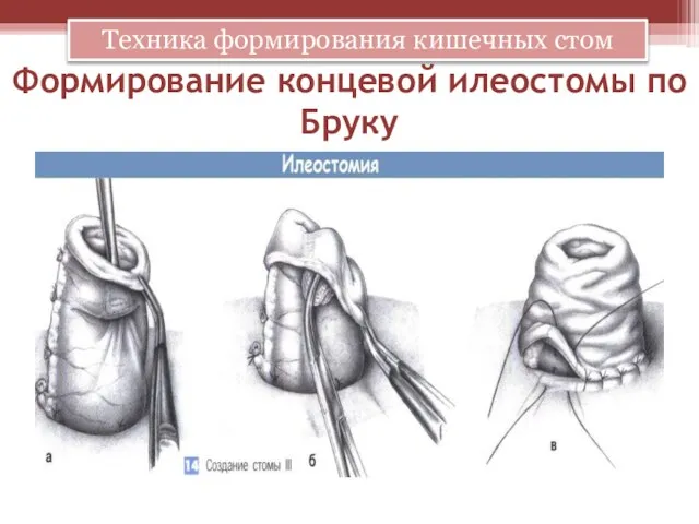 Формирование концевой илеостомы по Бруку Техника формирования кишечных стом