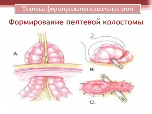 Формирование пелтевой колостомы Техника формирования кишечных стом